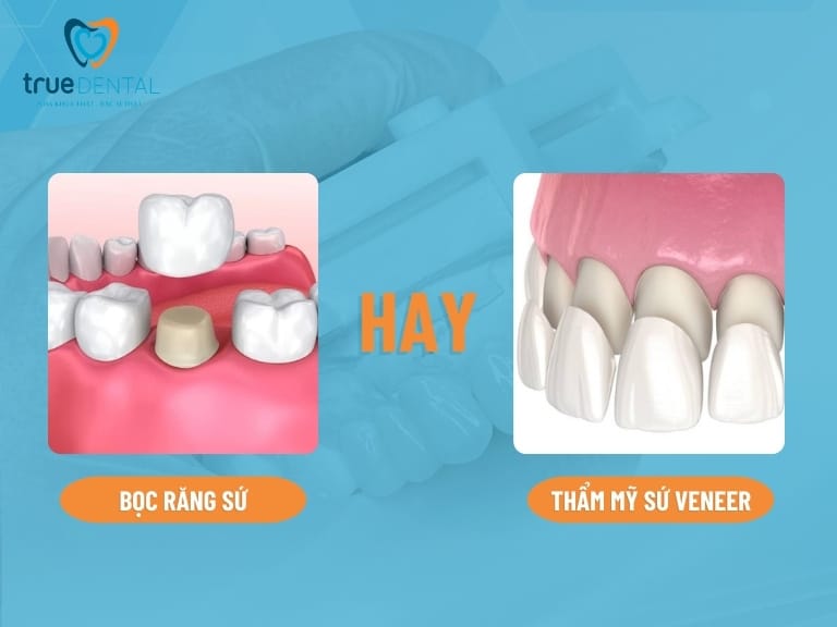 NÊN BỌC RĂNG SỨ HAY THẨM MỸ SỨ VENEER? PHƯƠNG PHÁP NÀO TỐT HƠN? 4 Nên bọc răng sứ hay thẩm mỹ sứ Veneer