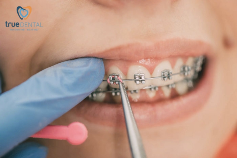 Các loại mắc cài niềng răng đang có mặt trên thị trường 8 Niềng răng có lâu không?