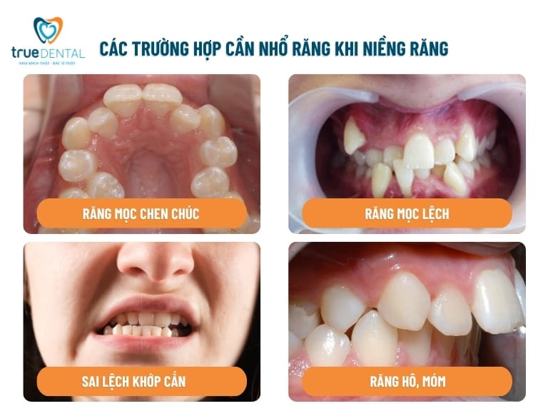 NIỀNG RĂNG CÓ PHẢI NHỔ RĂNG KHÔNG? CÓ ẢNH HƯỞNG GÌ KHÔNG? 2 4 trường hợp niềng răng phải nhổ răng