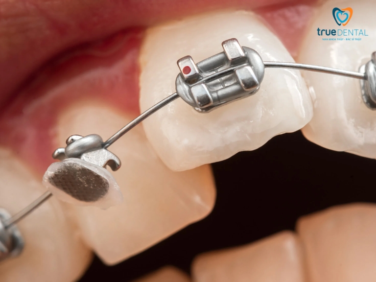 7 DẤU HIỆU NIỀNG RĂNG HỎNG BẠN CẦN BIẾT ĐỂ KHẮC PHỤC SỚM 1 niềng răng hỏng