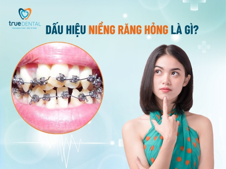 7 DẤU HIỆU NIỀNG RĂNG HỎNG BẠN CẦN BIẾT ĐỂ KHẮC PHỤC SỚM 2 dấu hiệu niềng răng hỏng