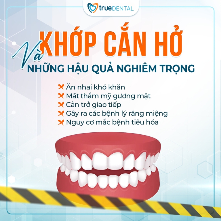 NIỀNG RĂNG KHỚP CẮN HỞ: PHƯƠNG PHÁP, THỜI GIAN VÀ CHI PHÍ 1 tác hại của khớp cắn hở