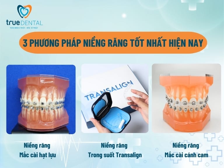 NIỀNG RĂNG LÀ GÌ? CÁC PHƯƠNG PHÁP VÀ THỜI GIAN NIỀNG 2 phuong phap nieng rang