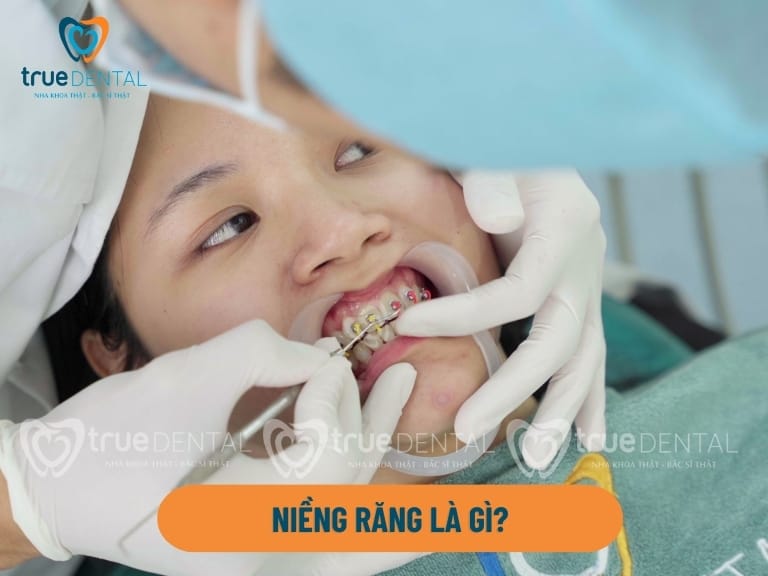 NIỀNG RĂNG LÀ GÌ? CÁC PHƯƠNG PHÁP VÀ THỜI GIAN NIỀNG 1 nieng rang la gi