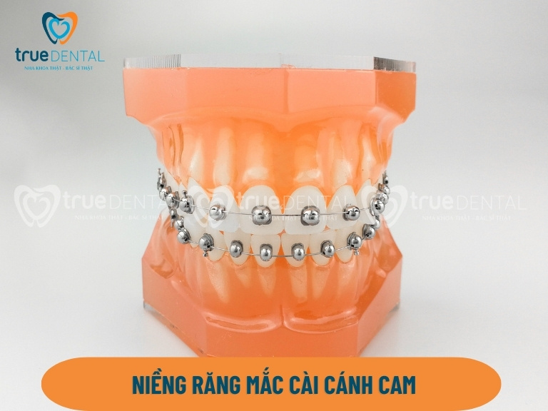 Niềng răng mắc cài cánh cam: Ưu nhược điểm, giá bao nhiêu 1 mắc cài cánh cam