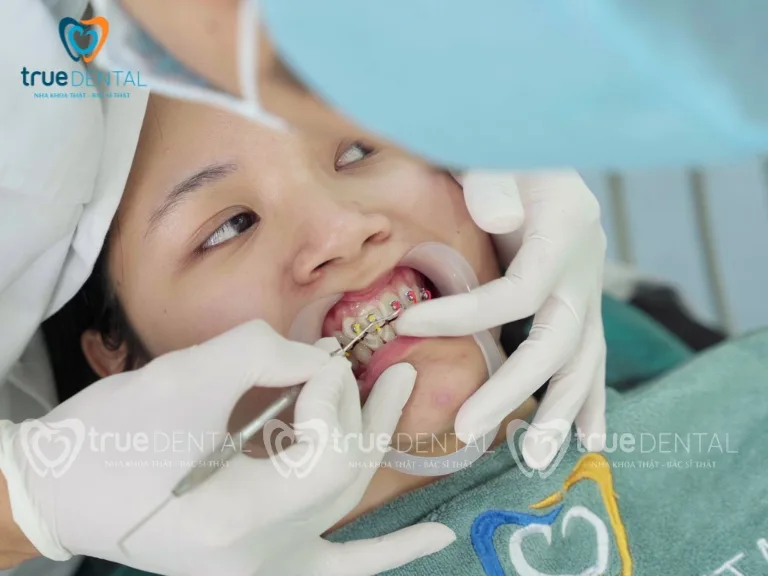 Niềng răng mắc cài cánh cam: Ưu nhược điểm, giá bao nhiêu 5 Niềng răng mắc cài cánh cam