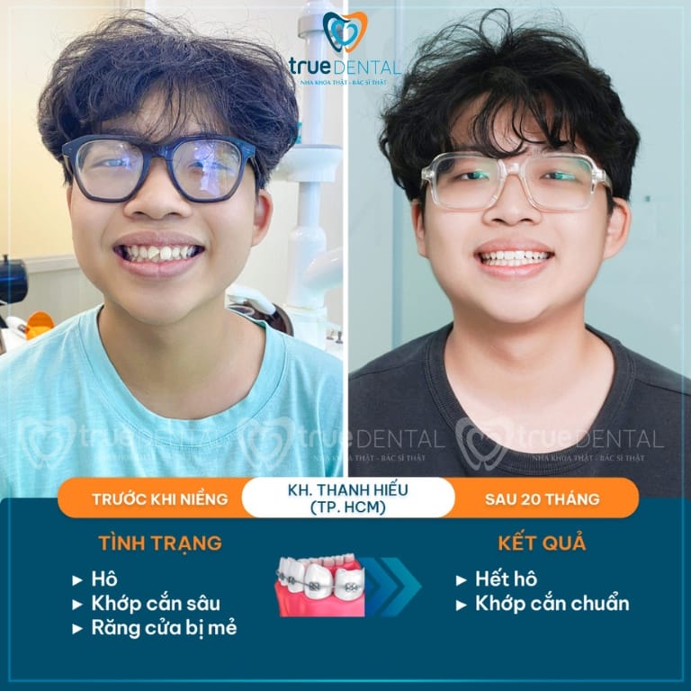 NIỀNG RĂNG MẮC CÀI KIM LOẠI LÀ GÌ? NHỮNG ĐIỀU BẠN CẦN BIẾT 6 ket qua nieng rang mac cai kim loai