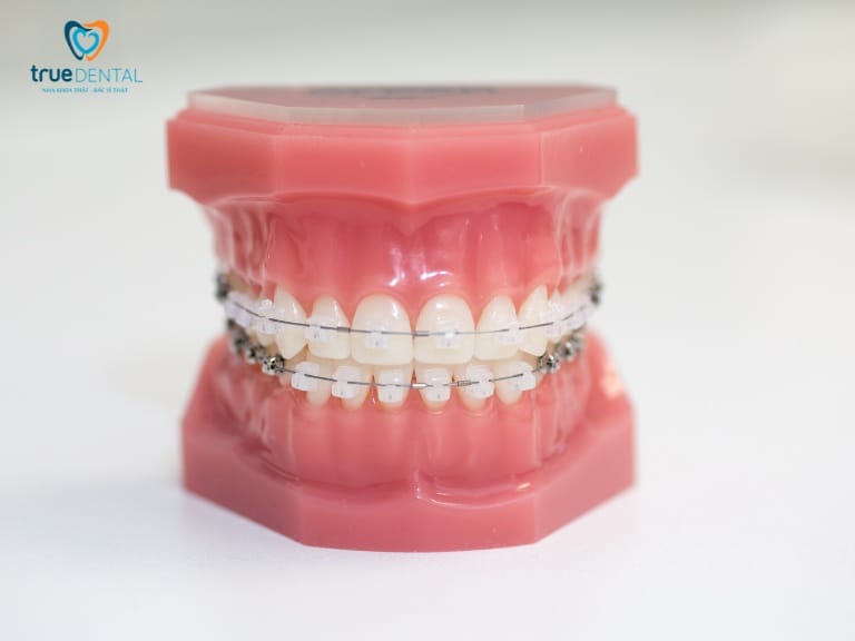 Niềng răng mắc cài được gắn vào răng như thế nào? 4 Mắc cài sứ