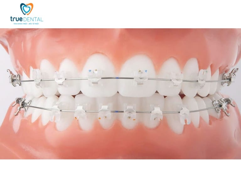 NIỀNG RĂNG MẮC CÀI SỨ THẨM MỸ VÀ NHỮNG ĐIỀU CẦN BIẾT 2 Niềng răng mắc cài sứ ưu và nhược điểm