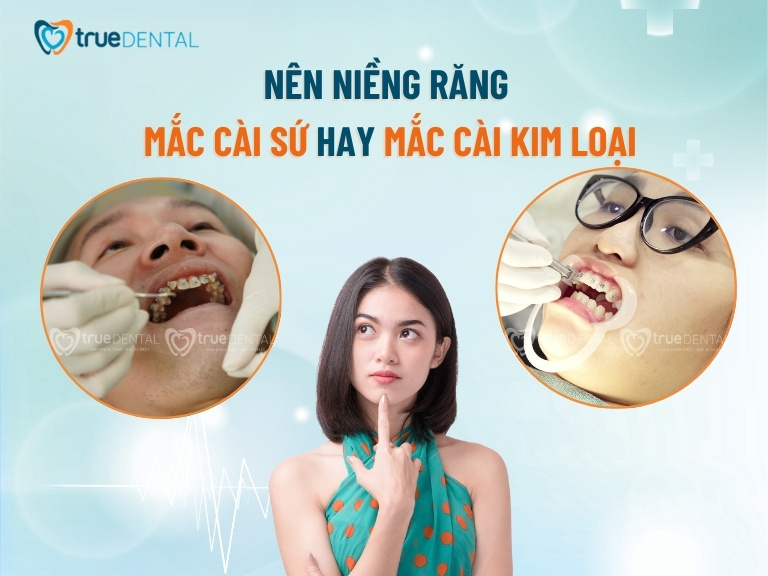 NÊN NIỀNG RĂNG MẮC CÀI SỨ HAY KIM LOẠI? SO SÁNH CHI TIẾT 1 nên niềng răng mắc cài sứ hay kim loại
