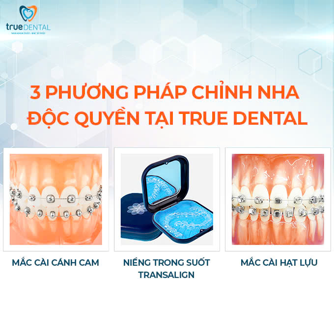 NIỀNG RĂNG SAU BAO LÂU THÌ ĐƯỢC ĂN UỐNG BÌNH THƯỜNG? 5 biện pháp niềng răng giúp thoải mái ăn uống bình thường