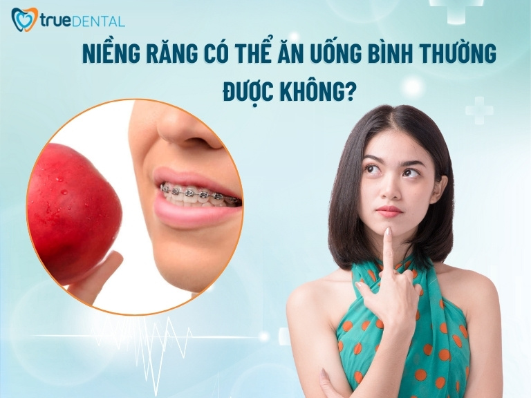 NIỀNG RĂNG SAU BAO LÂU THÌ ĐƯỢC ĂN UỐNG BÌNH THƯỜNG? 1 Niềng răng có ăn uống bình thường được không