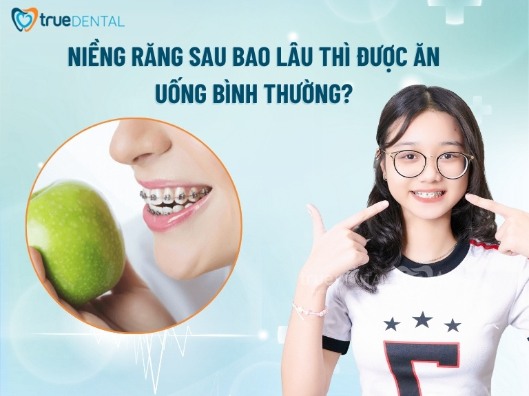 NIỀNG RĂNG SAU BAO LÂU THÌ ĐƯỢC ĂN UỐNG BÌNH THƯỜNG? 2 Niềng răng sau bao lâu thì được ăn uống bình thường?
