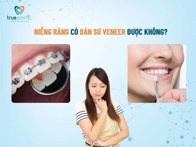 NHỮNG TRƯỜNG HỢP NÊN NIỀNG RĂNG TRƯỚC KHI DÁN SỨ VENEER 1 Niềng răng có làm thẩm mỹ sứ Veneer được không?
