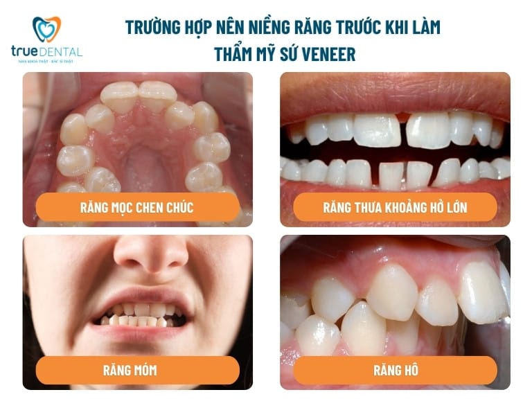 NHỮNG TRƯỜNG HỢP NÊN NIỀNG RĂNG TRƯỚC KHI DÁN SỨ VENEER 2 trường hợp cần niềng răng trước khi dán sứ