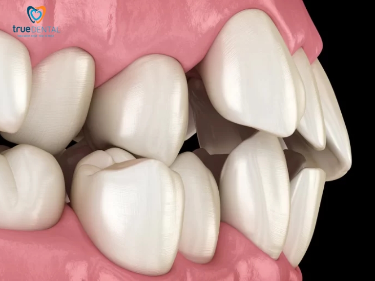 Răng mọc không đều có dán sứ Veneer được hay không?