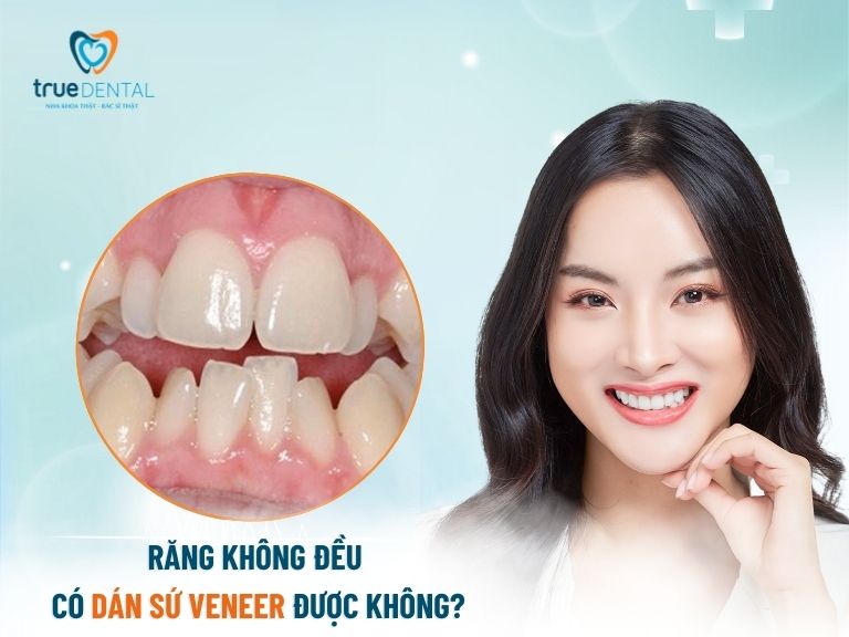 răng không đều có dán sứ Veneer được không?