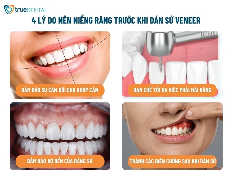 trường hợp răng mọc không đều nên niềng răng trước khi dán sứ Veneer
