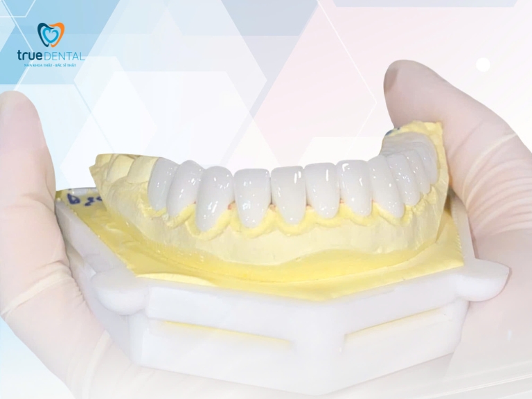 ĐỘ BỀN CỦA RĂNG SỨ VENEER ĐƯỢC BAO LÂU? NHỮNG YẾU TỐ ẢNH HƯỞNG TUỔI THỌ RĂNG SỨ 1 Răng sứ veneer là gì?