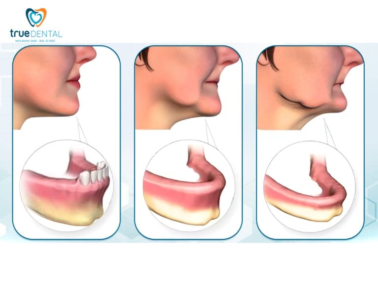 HIỆN TƯỢNG TIÊU XƯƠNG HÀM RĂNG: NGUYÊN NHÂN, DẤU HIỆU VÀ CÁCH ĐIỀU TRỊ 3 dấu hiệu tiêu xương hàm răng