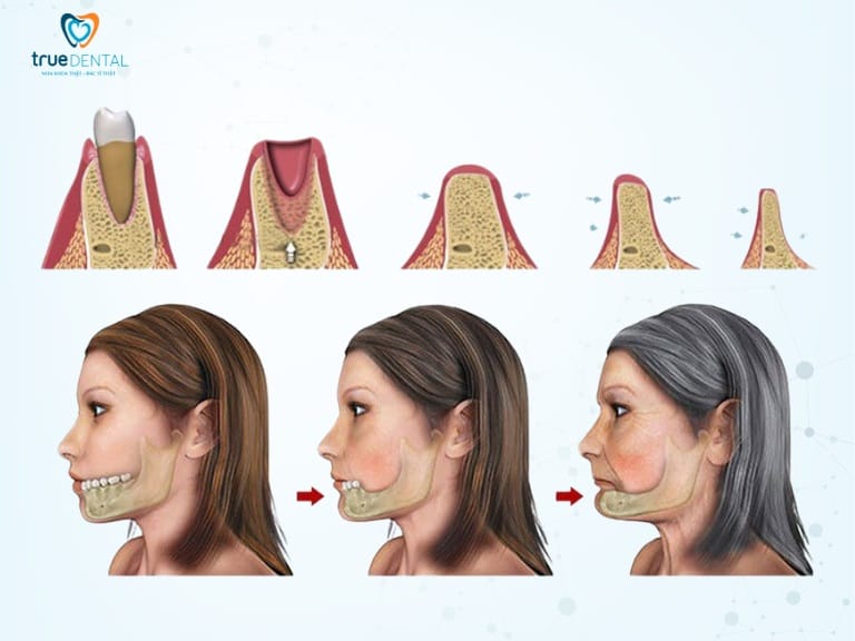 HIỆN TƯỢNG TIÊU XƯƠNG HÀM RĂNG: NGUYÊN NHÂN, DẤU HIỆU VÀ CÁCH ĐIỀU TRỊ 2 nguyên nhân tiêu xương hàm răng