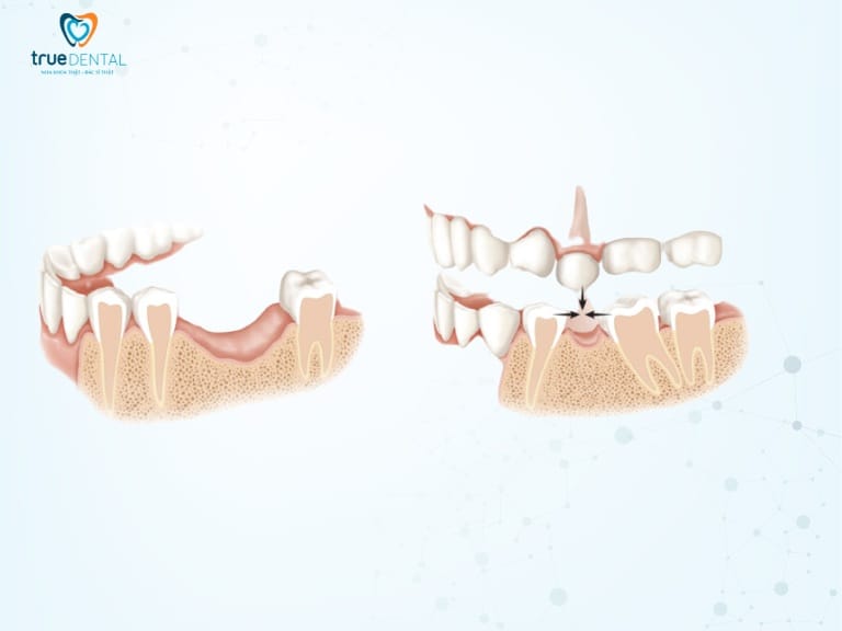 HIỆN TƯỢNG TIÊU XƯƠNG HÀM RĂNG: NGUYÊN NHÂN, DẤU HIỆU VÀ CÁCH ĐIỀU TRỊ 1 hiện tượng tiêu xương hàm răng