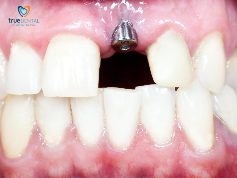 TRỒNG RĂNG IMPLANT CÓ ĐAU KHÔNG? NHỮNG LƯU Ý CẦN BIẾT 2 trồng răng implant đau không