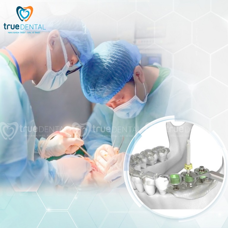 TRỒNG RĂNG IMPLANT CÓ ĐAU KHÔNG? NHỮNG LƯU Ý CẦN BIẾT 3 phương pháp trông răng implant không đau