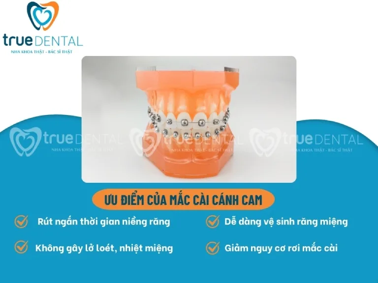 Niềng răng mắc cài cánh cam: Ưu nhược điểm, giá bao nhiêu 4 uu diem mac cai canh cam