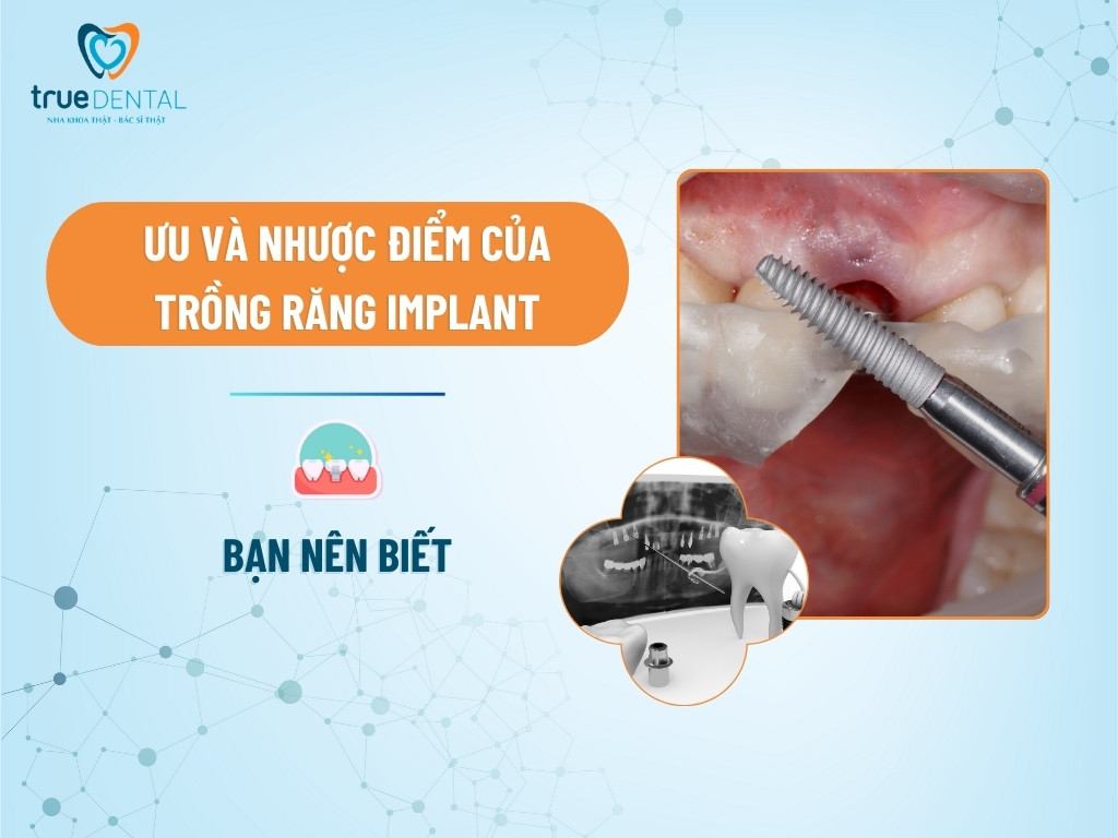 ƯU VÀ NHƯỢC ĐIỂM CỦA TRỒNG RĂNG IMPLANT BẠN NÊN BIẾT 10 ƯU VÀ NHƯỢC ĐIỂM CỦA TRỒNG RĂNG IMPLANT BẠN NÊN BIẾT