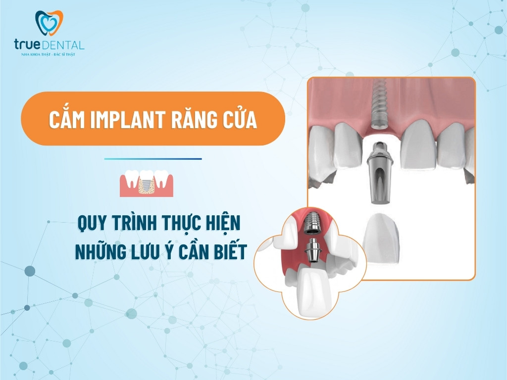 CẮM IMPLANT RĂNG CỬA: QUY TRÌNH THỰC HIỆN VÀ NHỮNG ĐIỀU CẦN BIẾT 1 CẮM IMPLANT RĂNG CỬA: QUY TRÌNH THỰC HIỆN VÀ NHỮNG LƯU Ý CẦN BIẾT