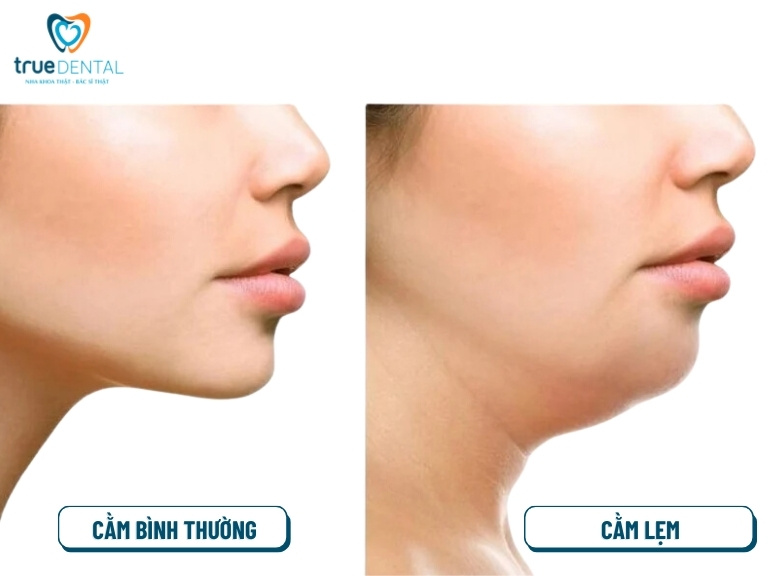 CẰM LẸM NIỀNG RĂNG CÓ ĐƯỢC KHÔNG? CÓ LÀM CẰM BỚT LẸM KHÔNG? 1 cằm lẹm là gì