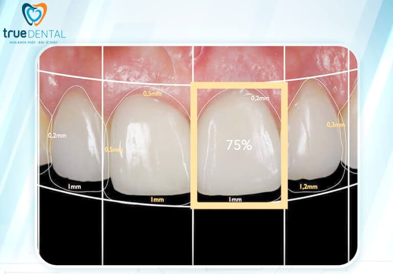 5 ĐẶC QUYỀN KHI CHỌN LÀM DỊCH VỤ THẨM MỸ SỨ VENEER ULTRA THIN TẠI TRUE DENTAL 4 đặc quyền thiết kế nụ cười cá nhân hóa khi chọn thẩm mỹ răng sứ Veneer