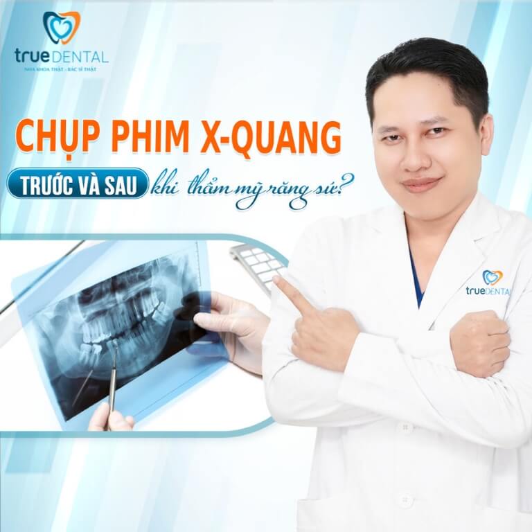 5 ĐẶC QUYỀN KHI CHỌN LÀM DỊCH VỤ THẨM MỸ SỨ VENEER ULTRA THIN TẠI TRUE DENTAL 5 đặc quyền chụp X-Quang răng trước và sau khi thẩm mỹ răng sứ Veneer