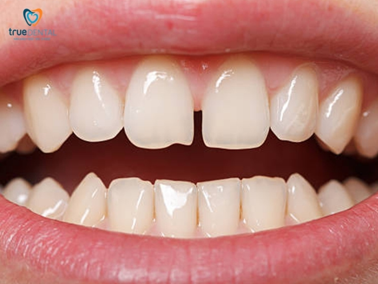 DÁN SỨ VENEER CHO RĂNG THƯA CÓ ĐƯỢC KHÔNG? CHI PHÍ BAO NHIÊU? 1 Dán sứ Veneer có khắc phục được răng thưa hay không