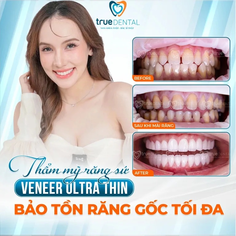 DÁN SỨ VENEER CHO RĂNG THƯA CÓ ĐƯỢC KHÔNG? CHI PHÍ BAO NHIÊU? 4 địa chỉ dán sứ Veneer cho răng thưa