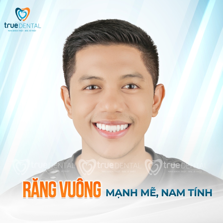 TOP 3 DÁNG RĂNG SỨ VENEER ĐẸP ĐƯỢC ƯA CHUỘNG NHẤT HIỆN NAY 3 Dáng răng sứ Veneer đẹp cho nam giới