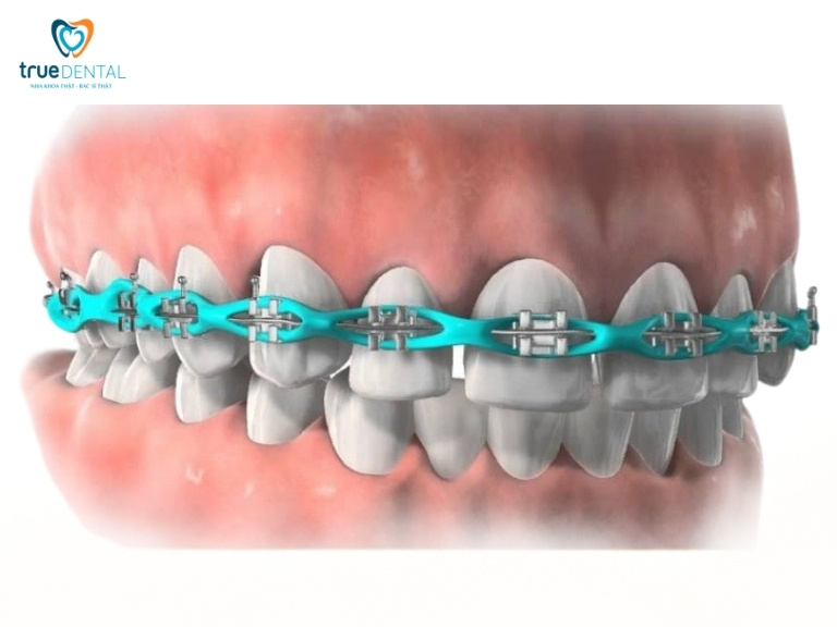 DÂY THUN NIỀNG RĂNG LÀ GÌ? CÓ TÁC DỤNG GÌ? 5 chun chuỗi