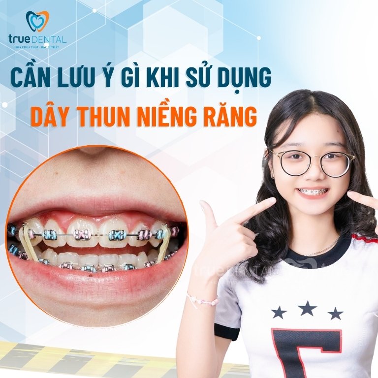 DÂY THUN NIỀNG RĂNG LÀ GÌ? CÓ TÁC DỤNG GÌ? 6 lưu ý khi sử dụng dây thun niềng răng