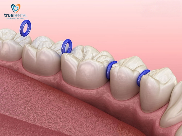 DÂY THUN NIỀNG RĂNG LÀ GÌ? CÓ TÁC DỤNG GÌ? 3 Chun tách kẻ