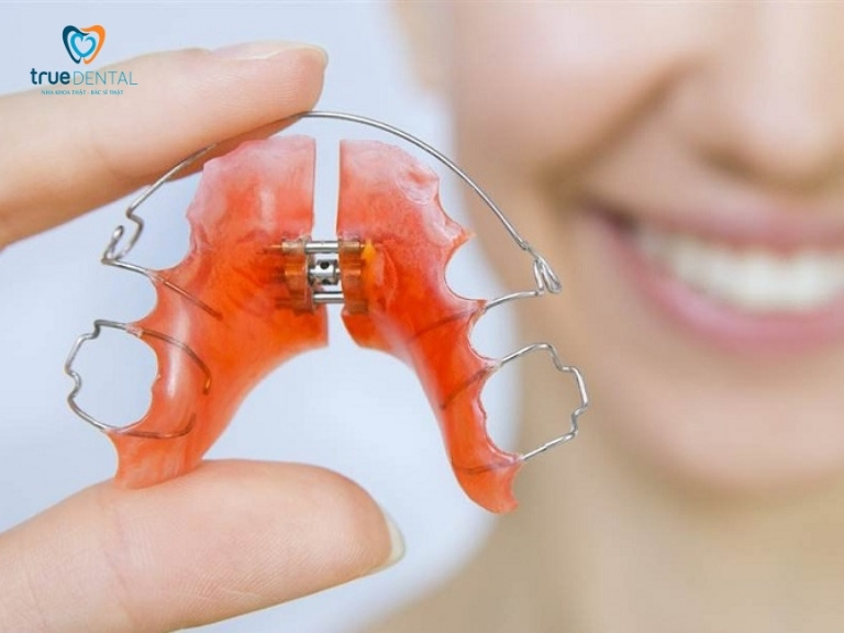TẠI SAO PHẢI ĐEO HÀM DUY TRÌ SAU NIỀNG RĂNG? CÓ PHẢI ĐEO CẢ ĐỜI KHÔNG? 1 hàm duy trì