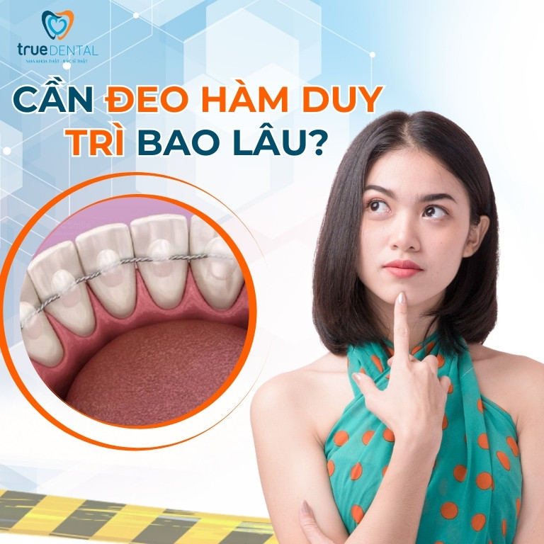 TẠI SAO PHẢI ĐEO HÀM DUY TRÌ SAU NIỀNG RĂNG? CÓ PHẢI ĐEO CẢ ĐỜI KHÔNG? 3 Cần đeo hàm duy trì bao lâu sau khi tháo niềng?