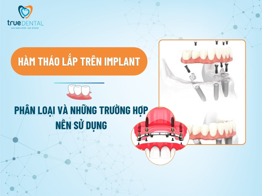 HÀM THÁO LẮP TRÊN IMPLANT: PHÂN LOẠI VÀ NHỮNG TRƯỜNG HỢP NÊN SỬ DỤNG 8 HÀM THÁO LẮP TRÊN IMPLANT: PHÂN LOẠI VÀ NHỮNG TRƯỜNG HỢP NÊN SỬ DỤNG