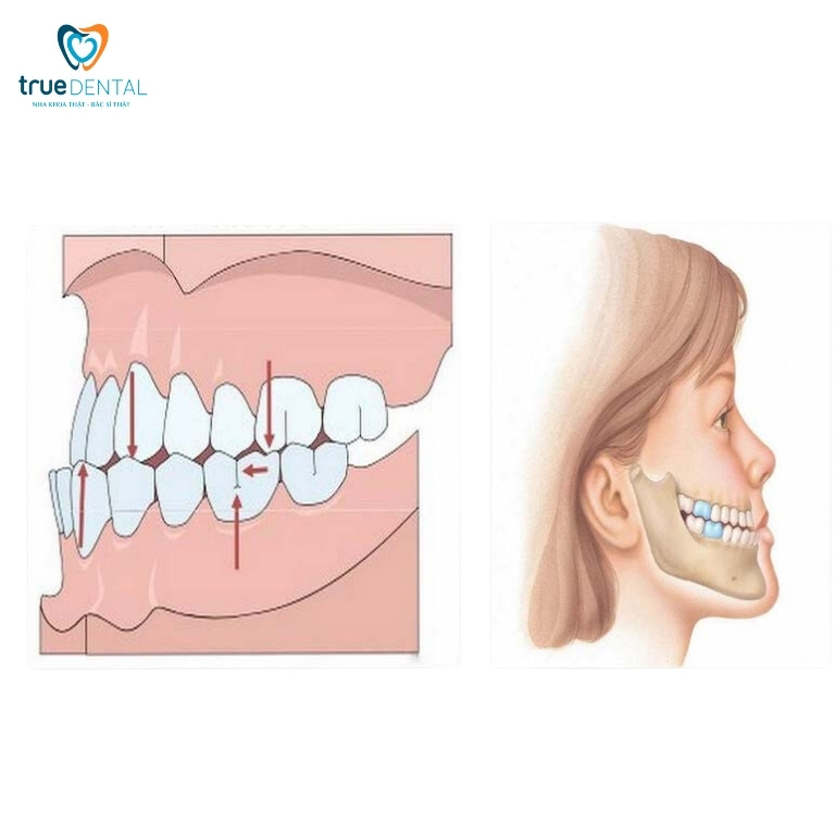 NIỀNG RĂNG KHỚP CẮN NGƯỢC VÀ NHỮNG ĐIỀU BẠN CẦN BIẾT 1 Khớp cắn ngược là gì?
