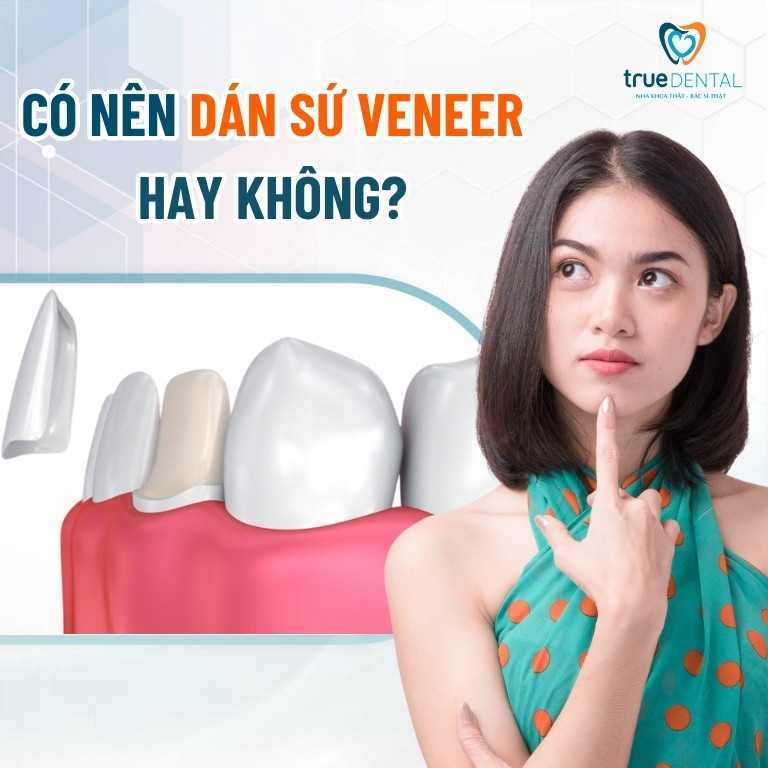 TỔNG HỢP NHỮNG KINH NGHIỆM DÁN SỨ VENEER MÀ BẠN NÊN BIẾT 1 kịnh nghiệm xác định có nên dán sứ Veneer không?