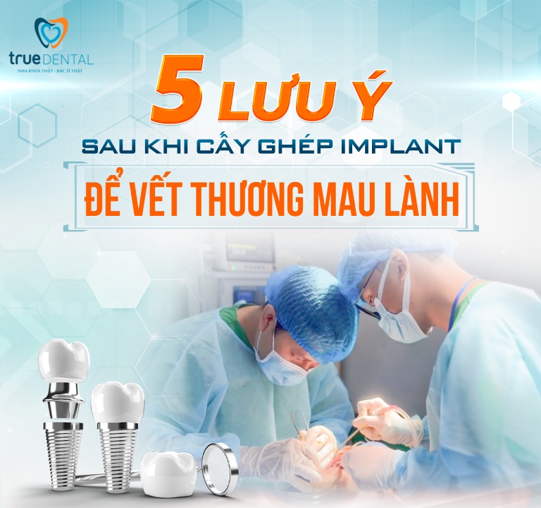 5 LƯU Ý SAU KHI CẤY GHÉP IMPLANT ĐỂ VẾT THƯƠNG MAU LÀNH 2 Lưu ý sau khi cấy ghép Implant