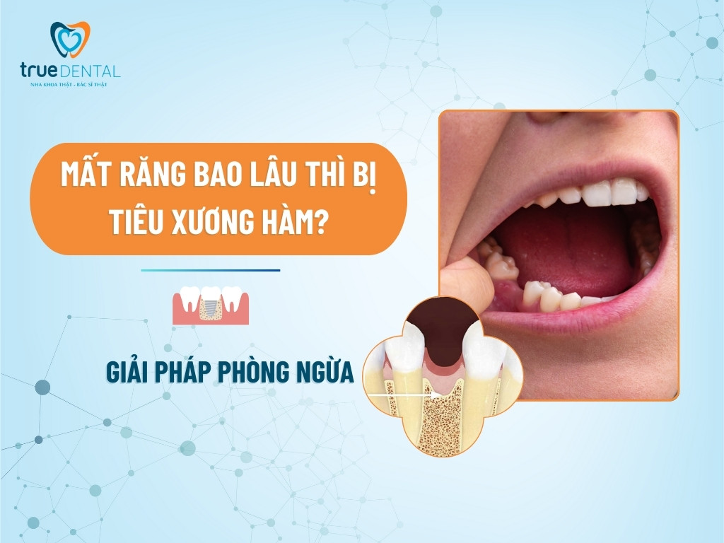 MẤT RĂNG BAO LÂU THÌ BỊ TIÊU XƯƠNG HÀM? GIẢI PHÁP PHÒNG NGỪA 2 MẤT RĂNG BAO LÂU THÌ BỊ TIÊU XƯƠNG HÀM? GIẢI PHÁP PHÒNG NGỪA