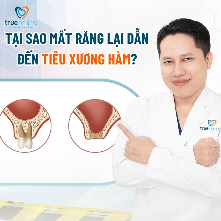 MẤT RĂNG BAO LÂU THÌ BỊ TIÊU XƯƠNG HÀM? GIẢI PHÁP PHÒNG NGỪA 2 Tại sao mất răng lại dẫn đến tiêu xương hàm?