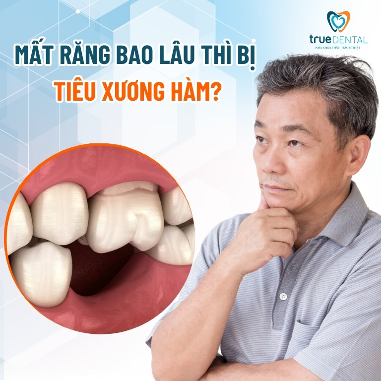 MẤT RĂNG BAO LÂU THÌ BỊ TIÊU XƯƠNG HÀM? GIẢI PHÁP PHÒNG NGỪA 3 Mất răng bao lâu thì bị tiêu xương hàm?