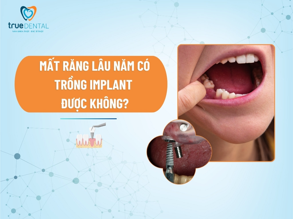[Giải đáp] Mất răng lâu năm có trồng implant được không? - True Dental ...